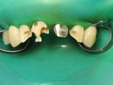 Реставрація фронтальних зубів
