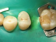 Реставрація зуба