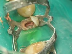 Реставрація зуба