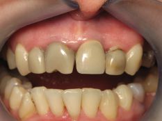 Реставрація фронтальних зубів