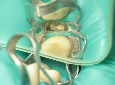 Відновлення зуба з кореня (варіант - 1)