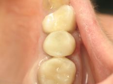 Відновлення зуба з кореня (варіант - 1)