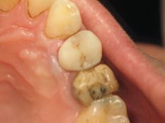 Відновлення зуба з кореня (варіант - 2)