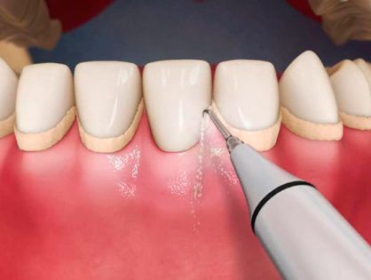 Видалення зубного каменя ультразвуком