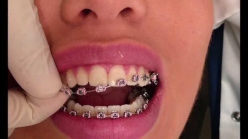 Зуби після брекетів: що стає із зубною емаллю